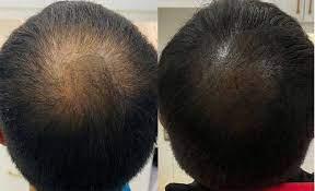 Why choose SMP over traditional hair loss solutions? 